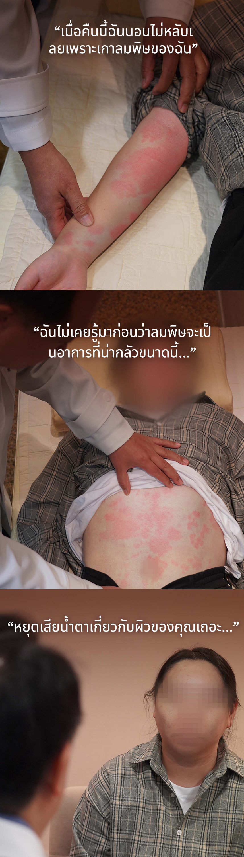 เมื่อคืนนี้ฉันนอนไม่หลับเลยเพราะเกาลมพิษของฉัน