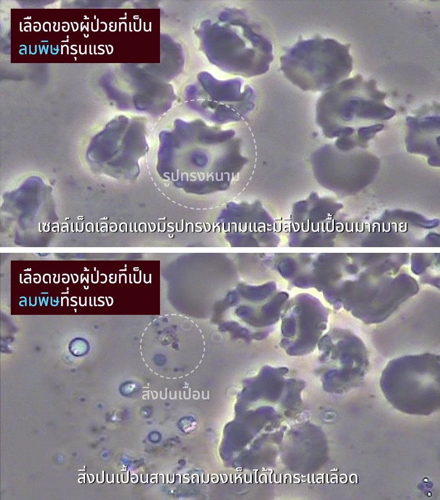 เลือดของผู้ป่วยที่เป็นลมพิษที่รุนแรง