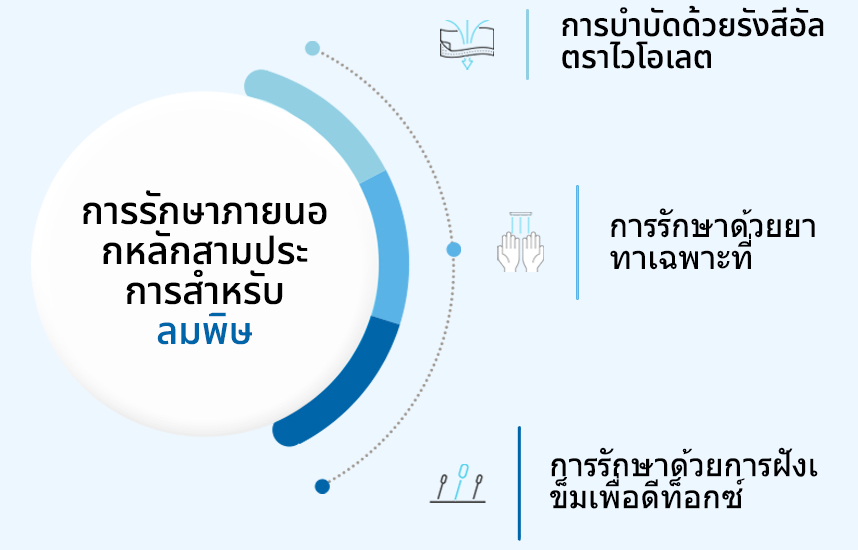 การรักษาภายนอกหลักสามประการสำหรับลมพิษ:การบำบัดด้วยรังสีอัลตราไวโอเลต, การรักษาด้วยยาทาเฉพาะที่, การรักษาด้วยการฝังเข็มเพื่อดีท็อกซ์ 
