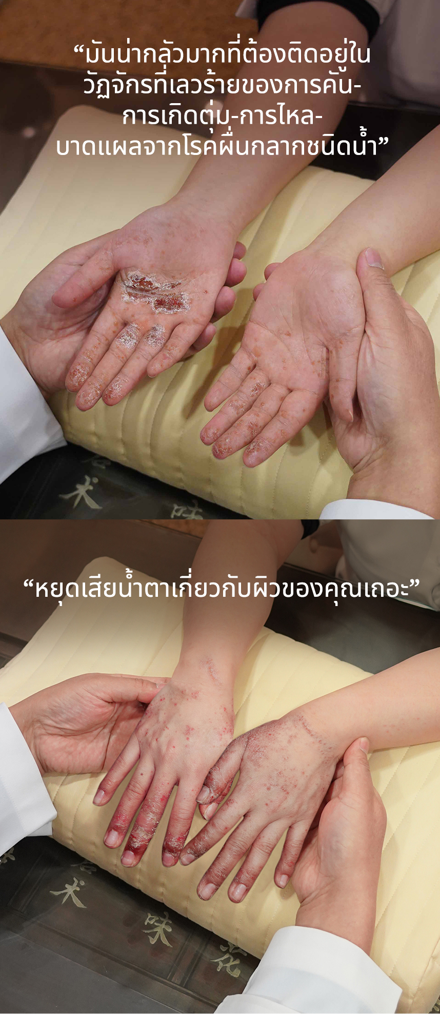 มันน่ากลัวมากที่ต้องติดอยู่ในวัฏจักรที่เลวร้ายของการคัน-การเกิดตุ่ม-การไหล-บาดแผลจากโรคผื่นกลากชนิดน้ำ