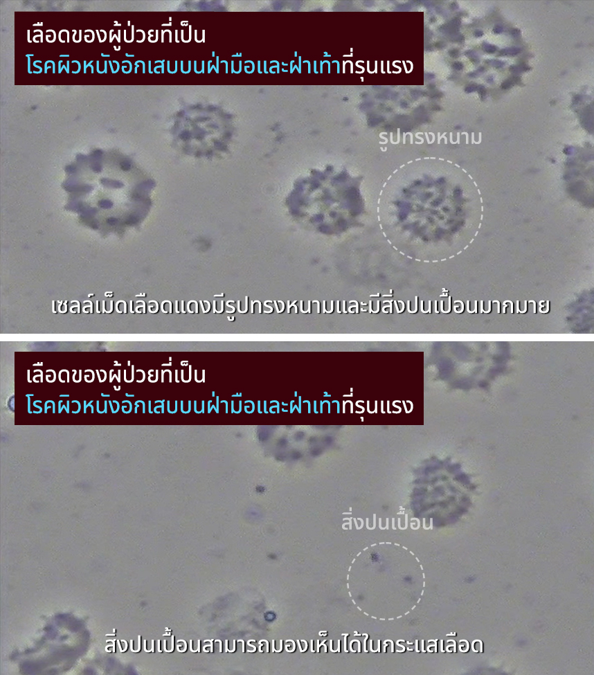 เลือดของผู้ป่วยที่เป็นโรคผิวหนังอักเสบบนฝ่ามือและฝ่าเท้าที่รุนแรง