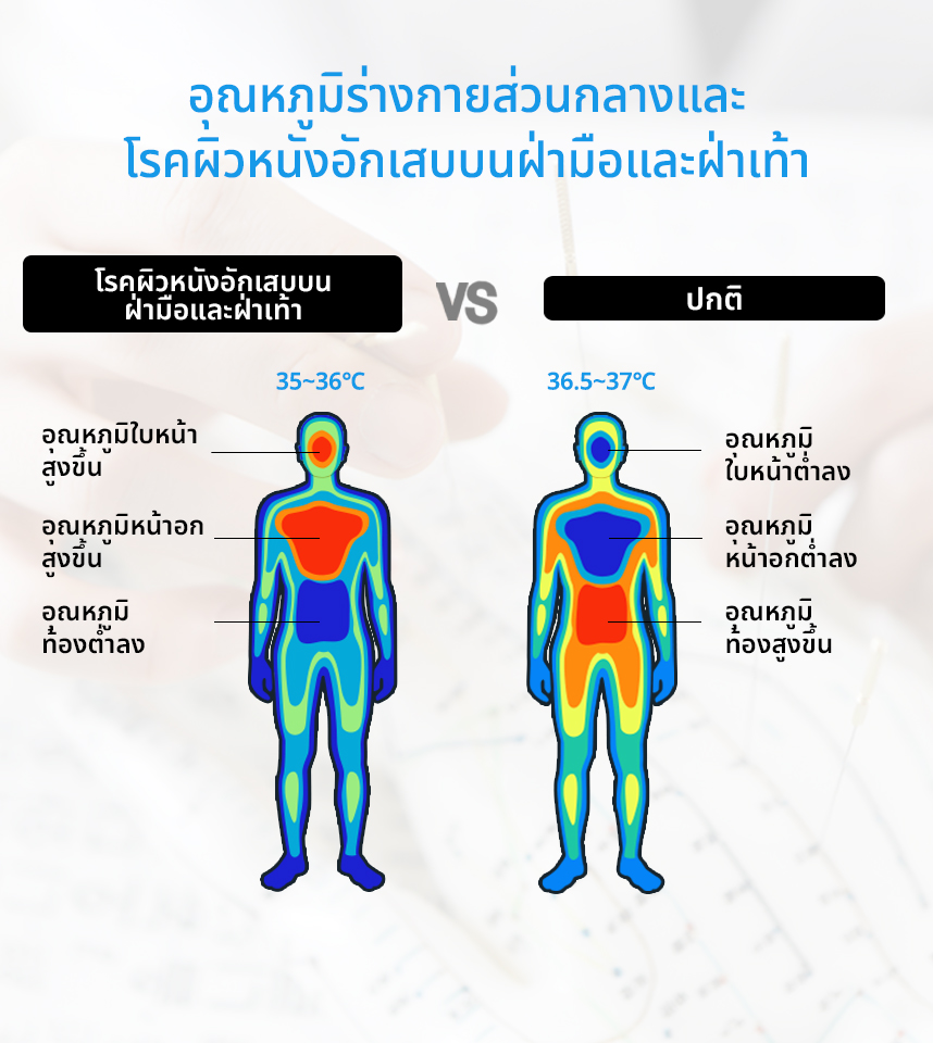 อุณหภูมิร่างกายส่วนกลางและโรคผิวหนังอักเสบบนฝ่ามือและฝ่าเท้า