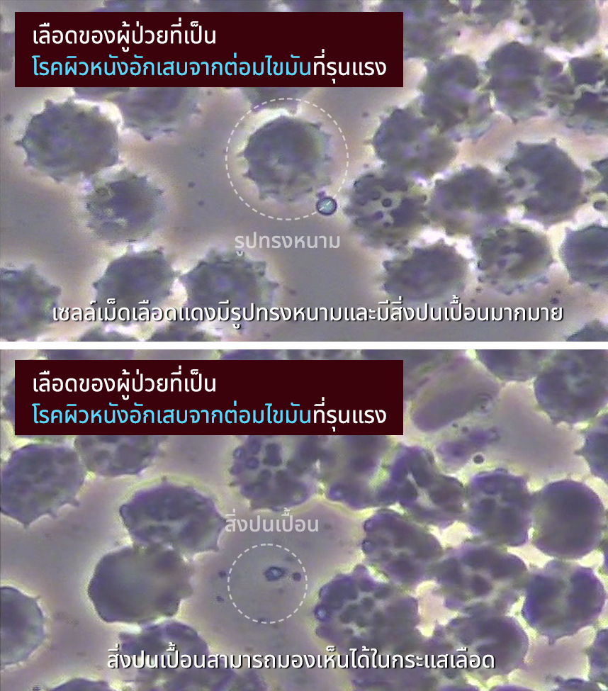 เลือดของผู้ป่วยที่เป็นโรคผิวหนังอักเสบจากต่อมไขมันที่รุนแรง