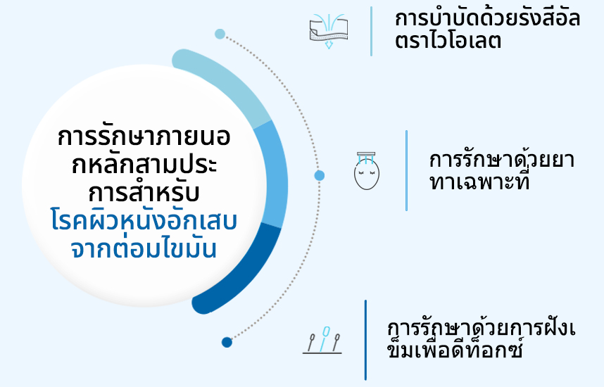 การรักษาภายนอกหลักสามประการสำหรับโรคผิวหนังอักเสบจากต่อมไขมัน:การบำบัดด้วยรังสีอัลตราไวโอเลต, การรักษาด้วยยาทาเฉพาะที่, การรักษาด้วยการฝังเข็มเพื่อดีท็อกซ์ 