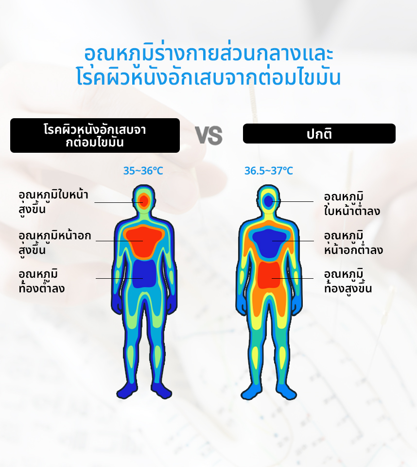 อุณหภูมิร่างกายส่วนกลางและโรคผิวหนังอักเสบจากต่อมไขมัน