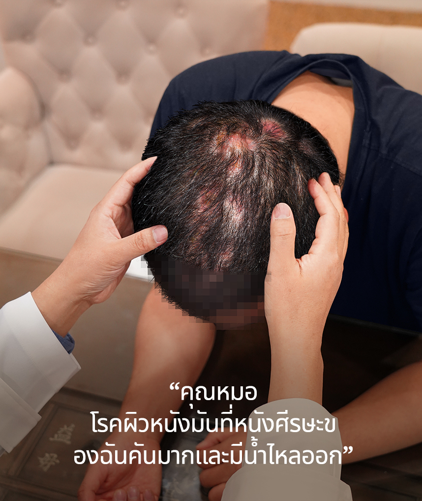 คุณหมอ โรคผิวหนังมันที่หนังศีรษะของฉันคันมากและมีน้ำไหลออก