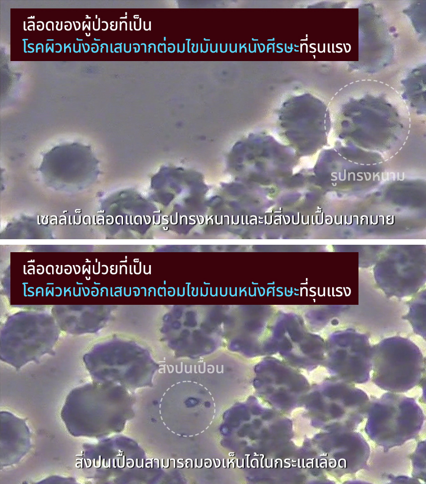 เลือดของผู้ป่วยที่เป็นโรคผิวหนังอักเสบจากต่อมไขมันบนหนังศีรษะที่รุนแรง