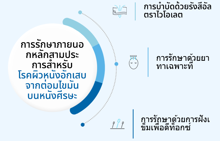 การรักษาภายนอกหลักสามประการสำหรับโรคผิวหนังอักเสบจากต่อมไขมันบนหนังศีรษะ:การบำบัดด้วยรังสีอัลตราไวโอเลต, การรักษาด้วยยาทาเฉพาะที่, การรักษาด้วยการฝังเข็มเพื่อดีท็อกซ์ 