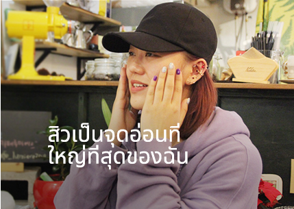 สิวเป็นจุดอ่อนที่ใหญ่ที่สุดของฉัน