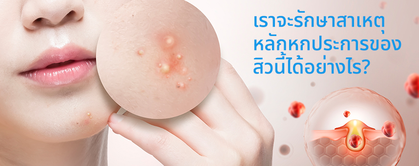 เราจะรักษาสาเหตุหลักหกประการของโรคสะเก็ดเงินนี้ได้อย่างไร?