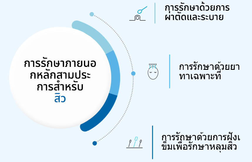 การรักษาภายนอกหลักสามประการสำหรับสิว