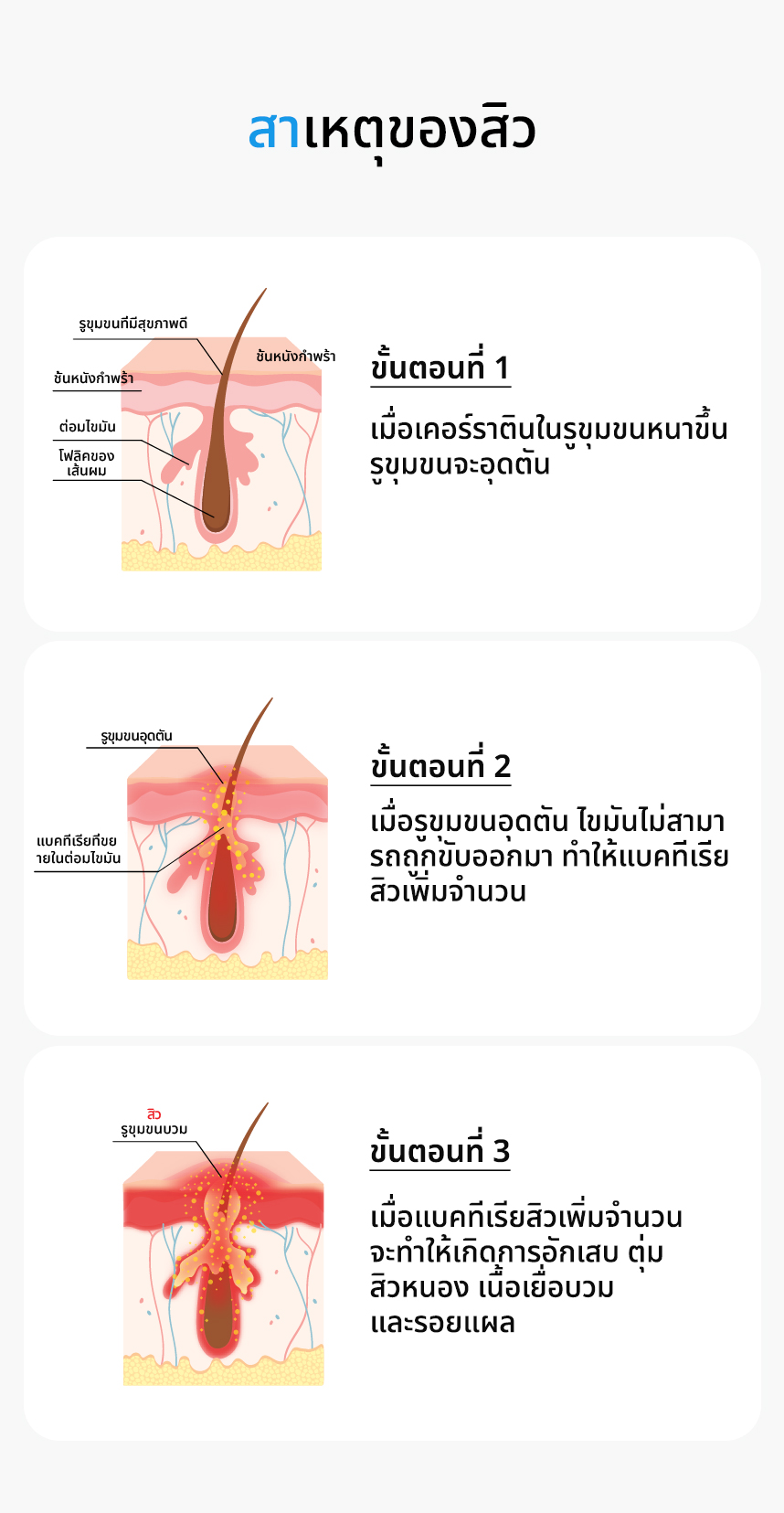 สาเหตุของสิว:ขั้นตอนที่ 1 : เมื่อเคอร์ราตินในรูขุมขนหนาขึ้น รูขุมขนจะอุดตัน, ขั้นตอนที่ 2 : เมื่อรูขุมขนอุดตัน ไขมันไม่สามารถถูกขับออกมา ทำให้แบคทีเรียสิวเพิ่มจำนวน, ขั้นตอนที่ 3 : เมื่อแบคทีเรียสิวเพิ่มจำนวน จะทำให้เกิดการอักเสบ ตุ่ม สิวหนอง เนื้อเยื่อบวม และรอยแผล
