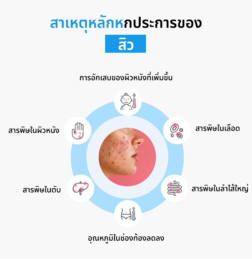 สาเหตุหลักหกประการของสิว: 
