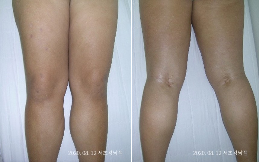 하늘마음한의원 청열 해독후 치료된 모습