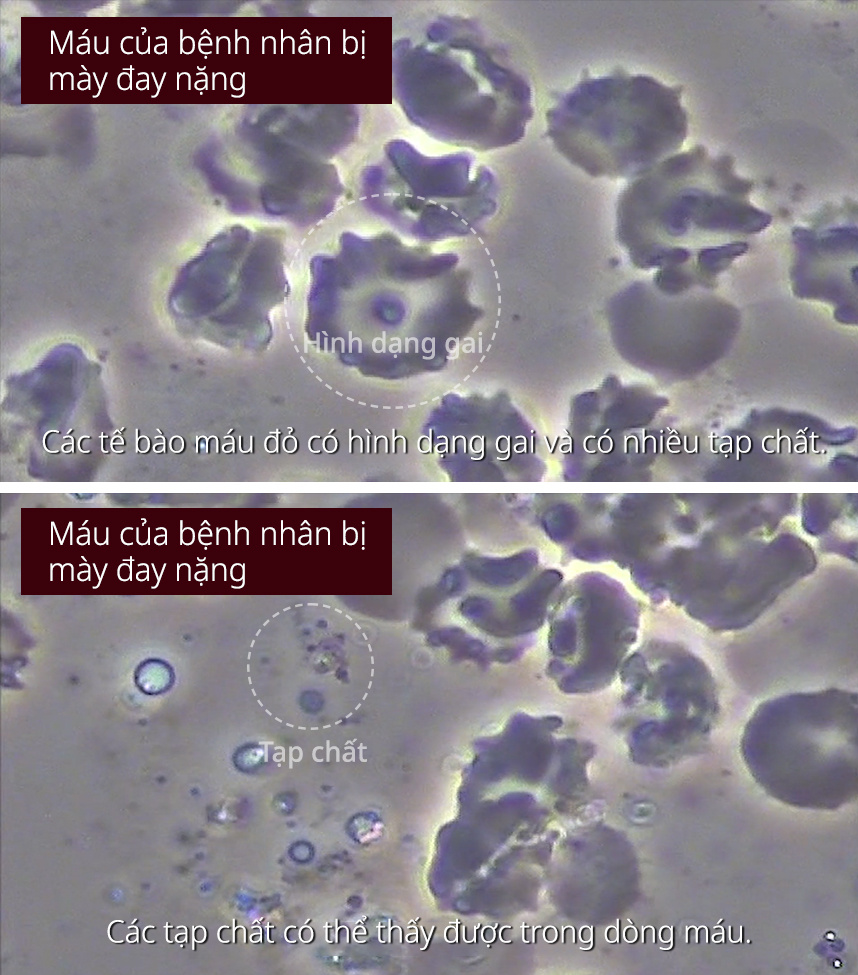 Máu của bệnh nhân bị Mày đay nặng