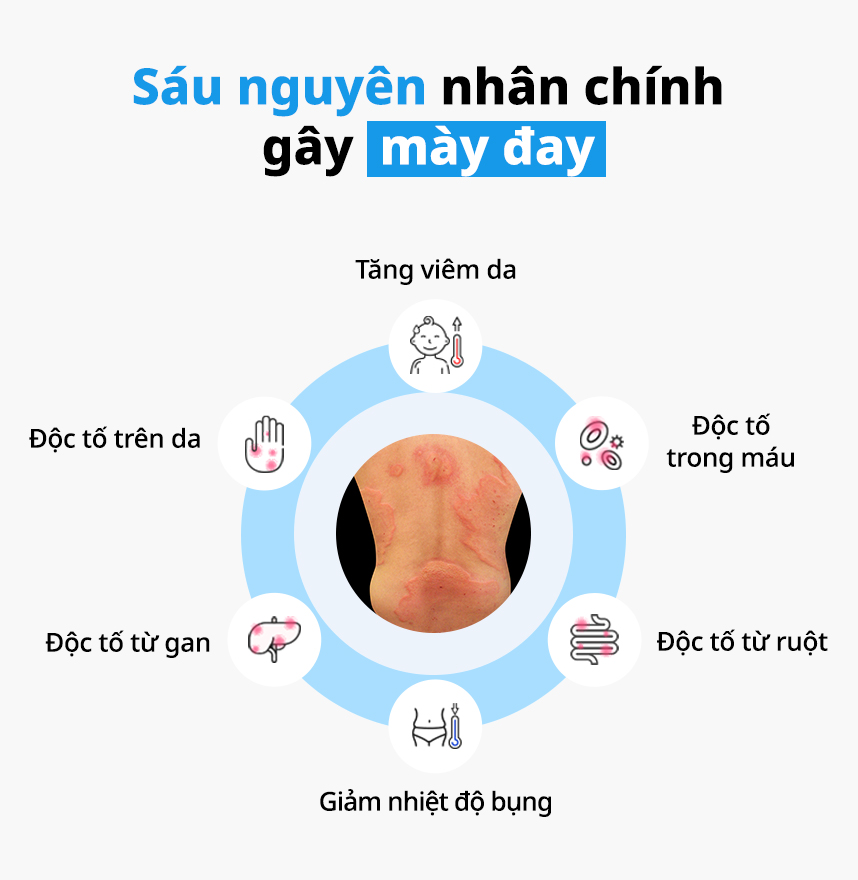 Sáu nguyên nhân chính gây Mày đay