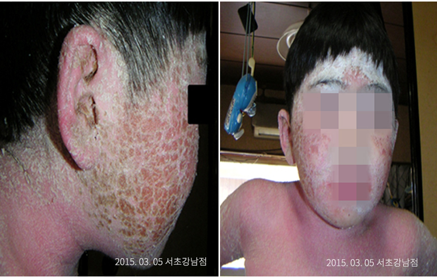 일본에서 온 온몸이 건선으로 뒤덮힌 환자
