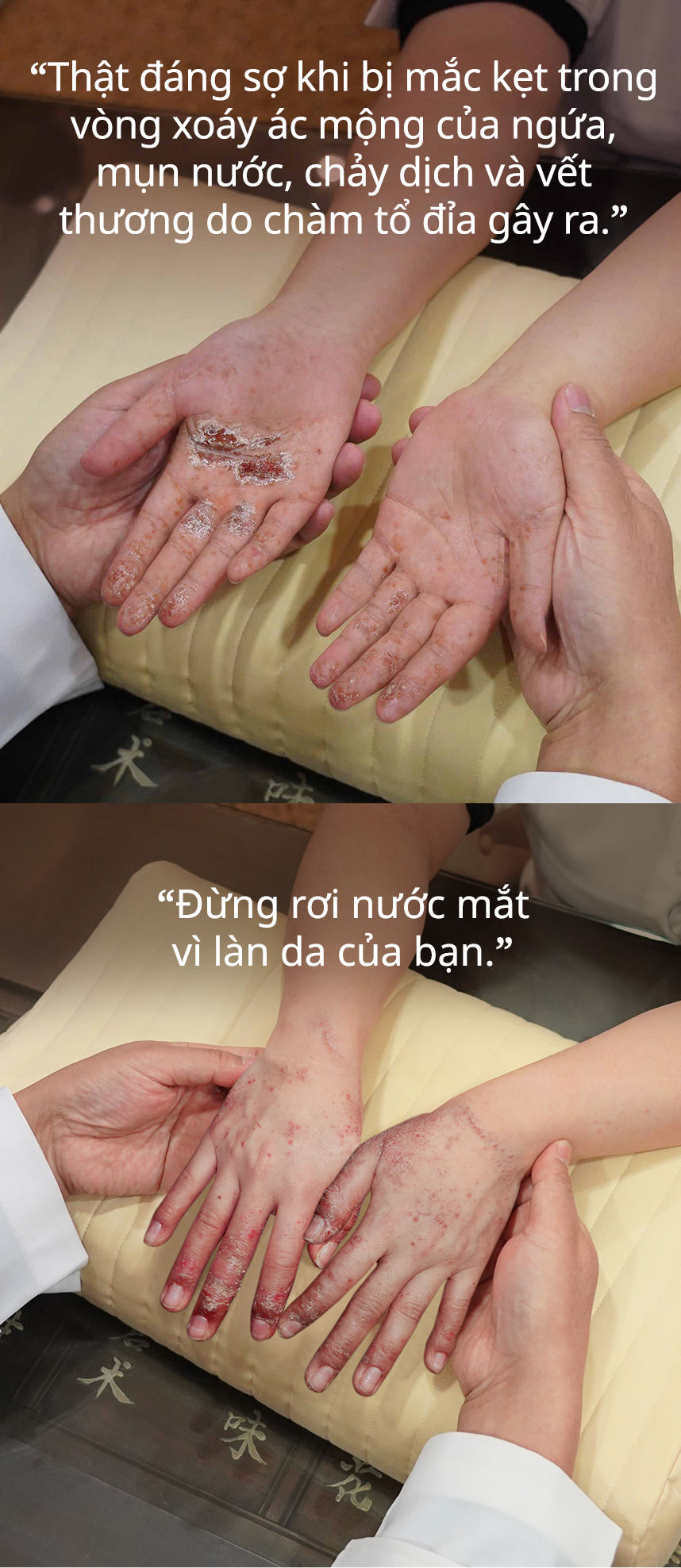 Thật đáng sợ khi bị mắc kẹt trong vòng xoáy ác mộng của ngứa, mụn nước, chảy dịch và vết thương do chàm tổ đỉa gây ra.