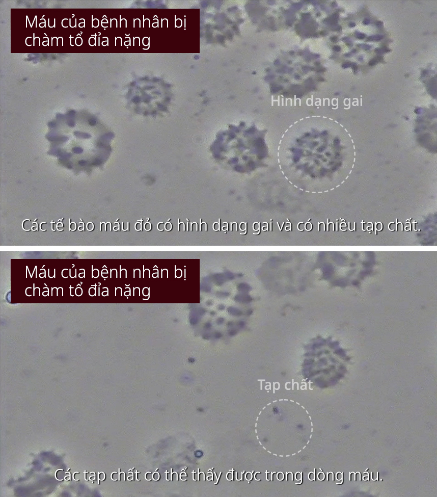 Máu của bệnh nhân bị Chàm tổ đỉa nặng