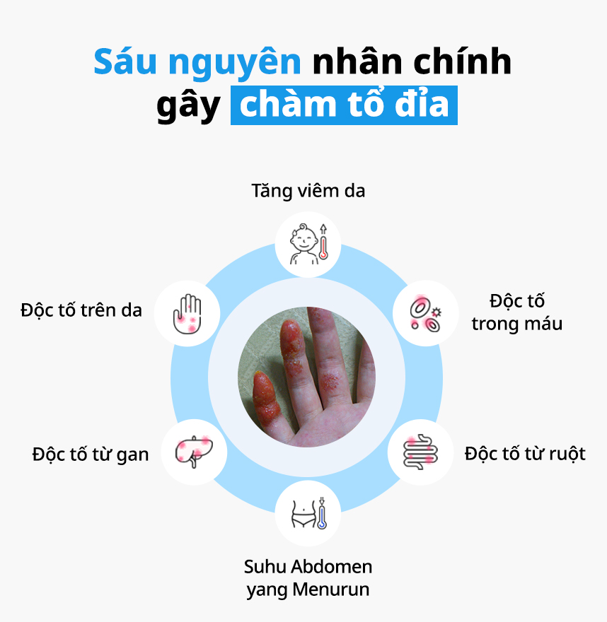 Sáu nguyên nhân chính gây Chàm tổ đỉa