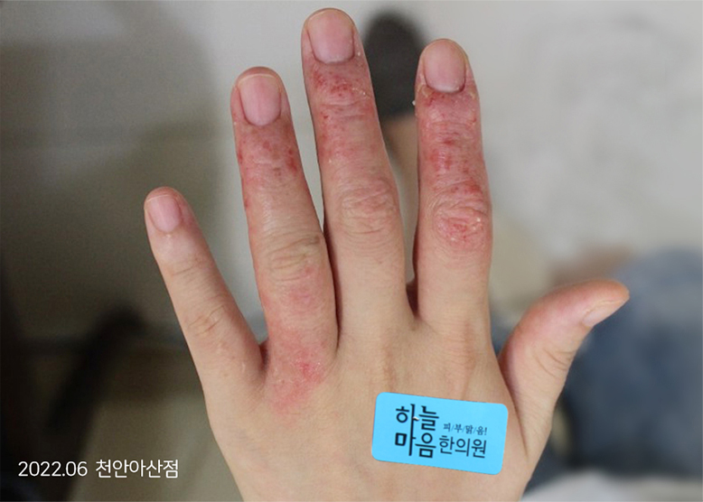 Trước Điều trị 