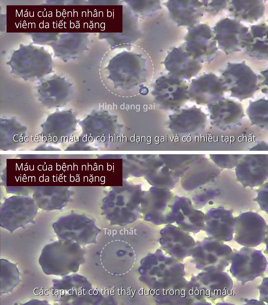 Máu của bệnh nhân bị viêm da tiết bã nặng