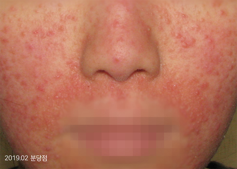 Trước Điều trị 