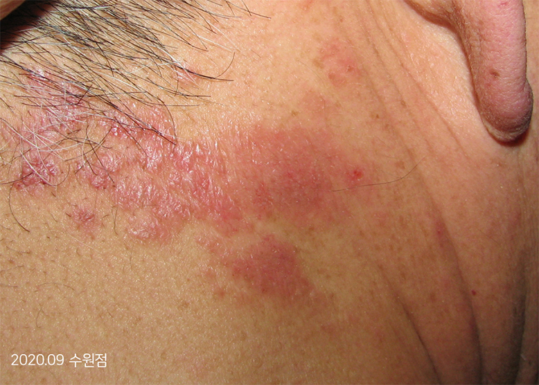 Trước Điều trị 