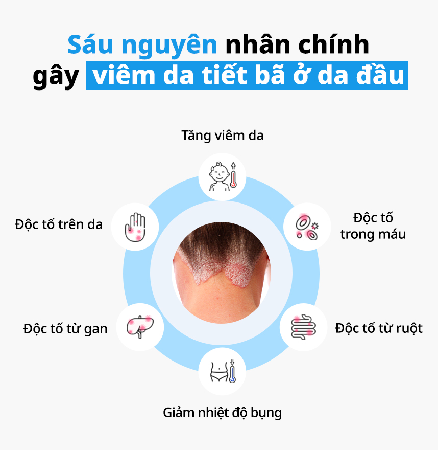 Sáu nguyên nhân chính gây Viêm da tiết bã ở da đầu