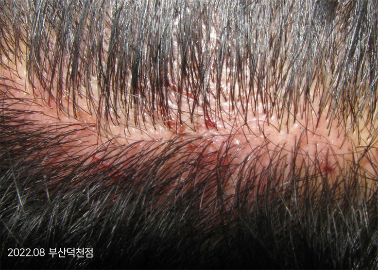 Trước Điều trị 