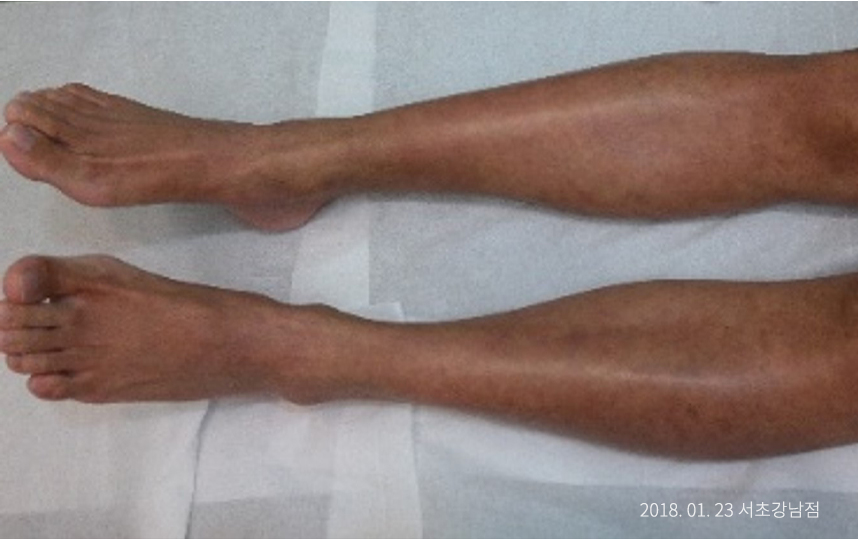 하늘마음한의원 청열 해독후 치료된 모습