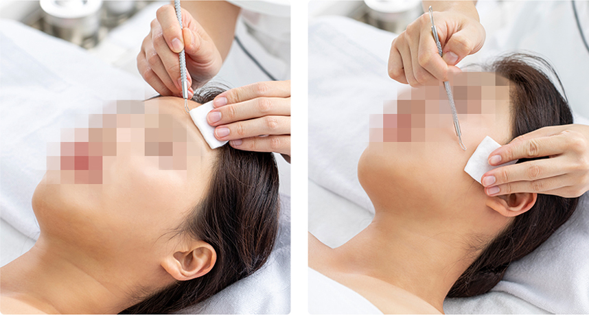 Điều trị cắt và dẫn lưu