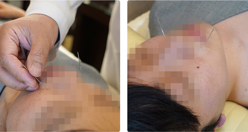 Châm cứu điều trị sẹo mụn