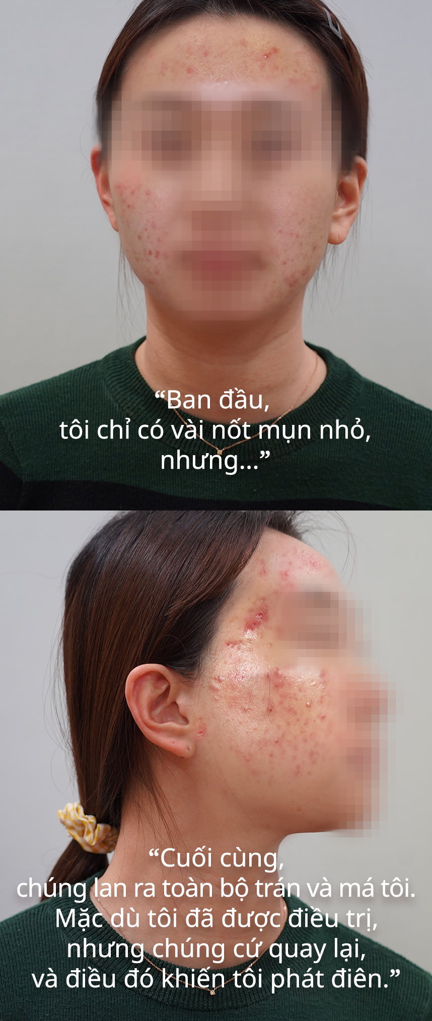 Ban đầu, tôi chỉ có vài nốt mụn nhỏ, nhưng...