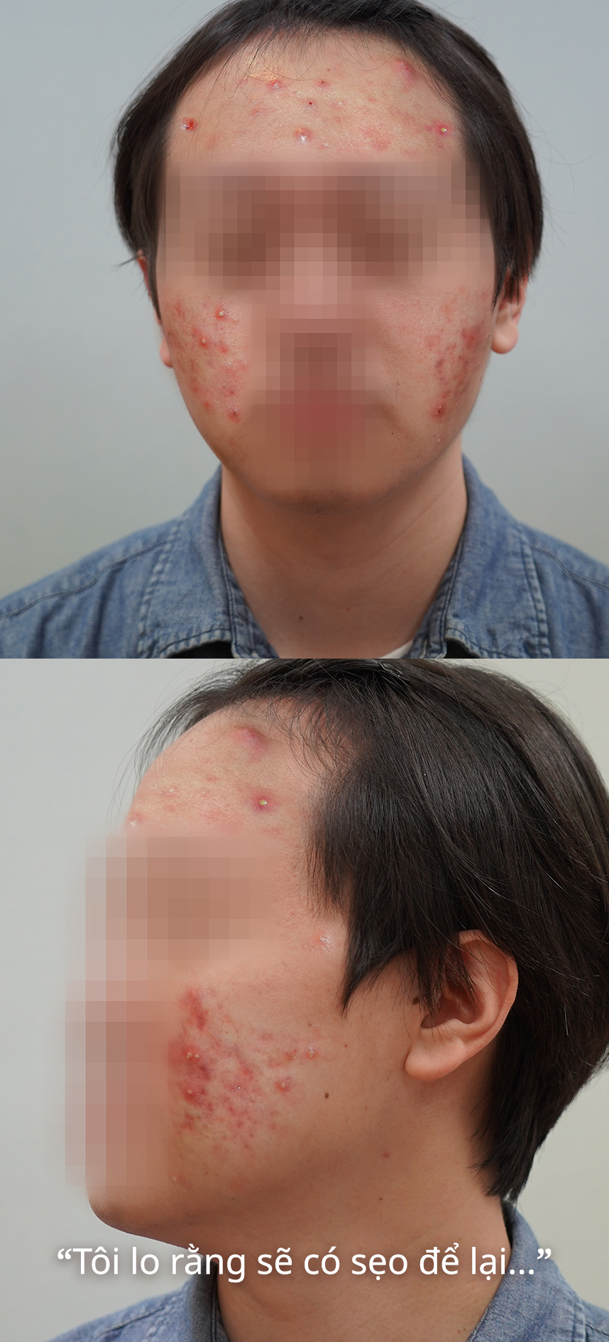 Tôi lo rằng sẽ có sẹo để lại...