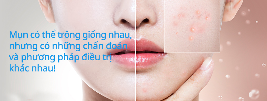 Mụn có thể trông giống nhau, nhưng có những chẩn đoán và phương pháp điều trị khác nhau!