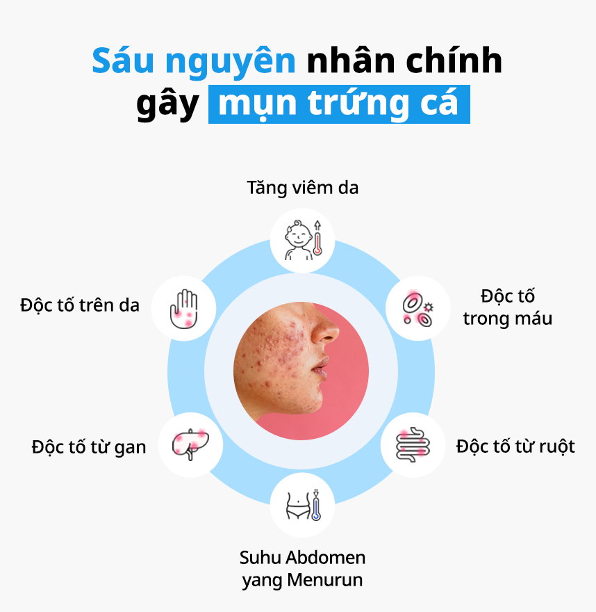 Sáu nguyên nhân chính gây mụn trứng cá